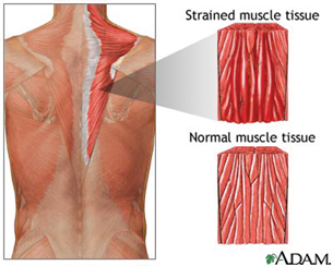 An illustration of a man's back shows a comparison between strained muscle tissue and normal muscle tissue.
