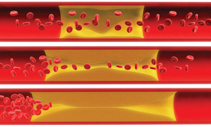 The top photo shows an initial buildup of plaque. The second picture shows fewer blood cells moving through the artery. The last picture shows a blockage. This is arteriolsclerosis.