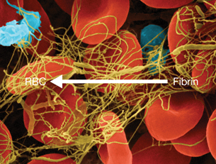 This is a three-D image of red blood cells and a fibrous string-like substance called fibrin.