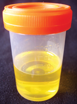 This photo is of a sample of urine in a cup used by clinics or hospitals.