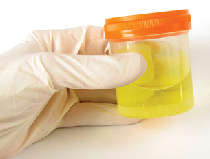 This is a photo of a gloved hand holding a sample of urine.