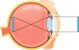 Diagram illustrates how light is refracted by the lens, focused, and projected on to the retina.