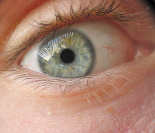 A photo of a constricted pupil, producing a small central dark area in the centre of the eye.
