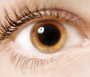 A photograph of a dilated pupil, producing a large central black area in the centre of the eye.