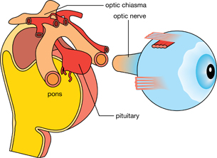The pituitary gland is situated between the two optic nerves and very close to the optic chiasma of the brain.  If it should enlarge then it will press on the optic nerve and/or the optic chiasma causing blurring of vision.
