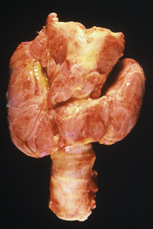 This photo oshows the abnormal enlargement of the thyroid gland.