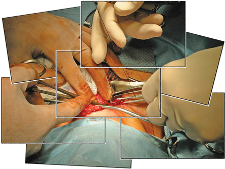 This photograph shows the surgical removal of the most active parts of an enlarge thyroid gland to overcome hyperthyroidism.