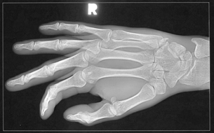 This photo shows an X-ray image of a human hand. People who oversecrete PTH will have fragile and easily broken bones.