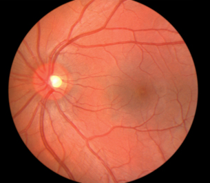 This photograph shows the blood vessels inside a human eye. Untreated diabetes mellitus causes the tiny blood vessels in the eye to rupture and bleed, causing blurred vision and, in the worst cases, blindness.
