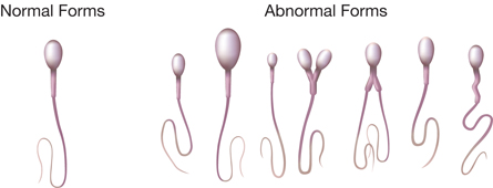 The diagram shows the various possibilities for abnormal spermshapes, for example two heads, two tails.