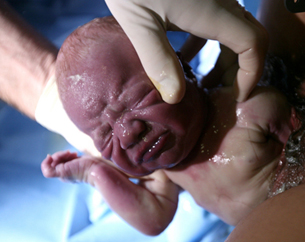 This photo shows a newborn as it is being vaginally delivered.