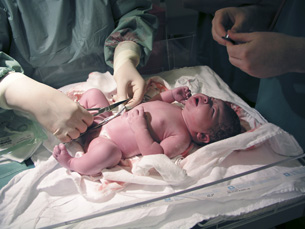 This photograph shows a newborn baby having its umbilical cord cut by medical staff.