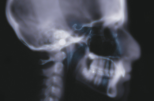 A photo shows an X-ray of a human skull. The teeth, jawbones, and vertebrae are visible. 