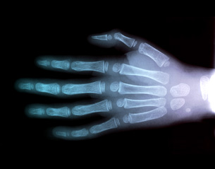 A photograph shows an X-ray of a hand.
