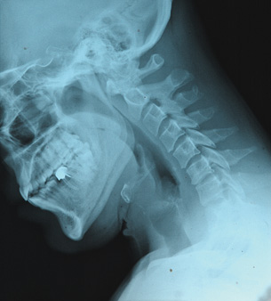 An X-ray image shows a head and neck. 