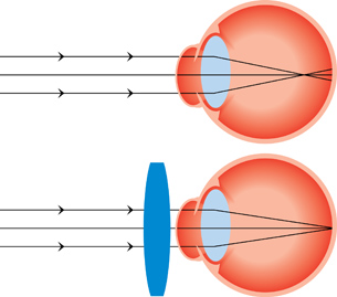 A diagram shows the cross-section of two hyperopic eyeballs. One shows lines converging behind the retina. The other has a corrective lens in front of it and shows the lines bent by the corrective lens and again by the pupil, and converging on the retina. 