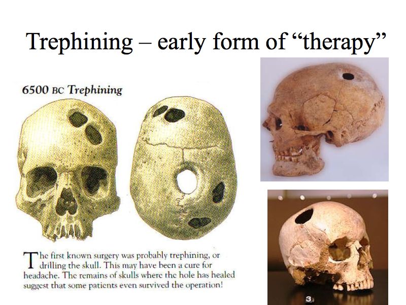 Trephining