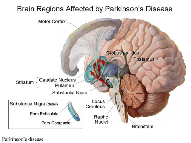 parkinsons