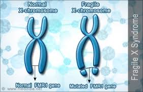 Fragile X Chromosome