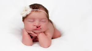 cleft lip