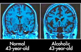 brain of alcoholic